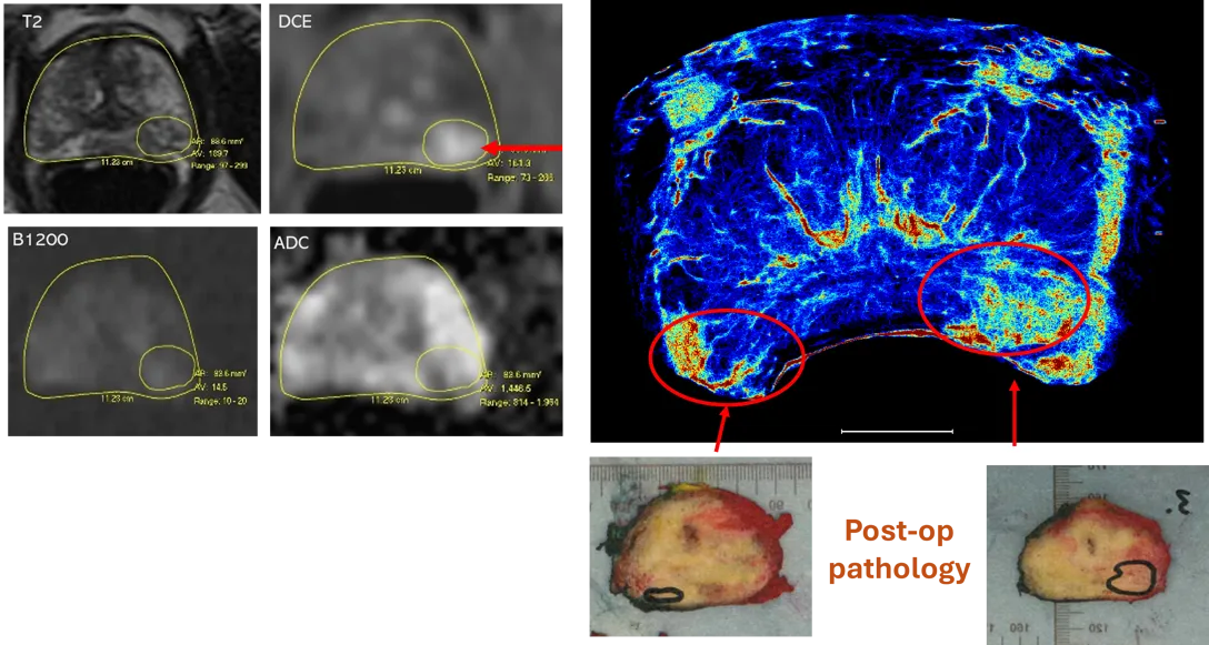 Image showing MRI images (left) and new super-resolution imaging (right) demonstrating missed tumour. Image showing MRI images (left) and new super-resolution imaging (right) demonstrating missed tumour.
